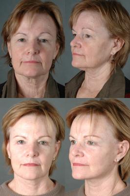 face-and-neck-lift-p1.jpg