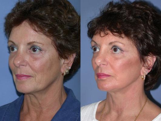 face-and-neck-lift-p11.jpg