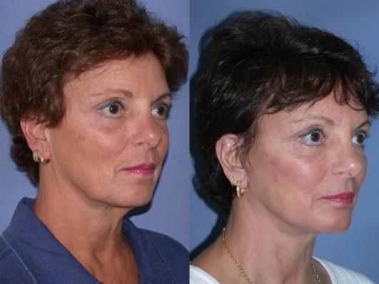 face-and-neck-lift-p12.jpg