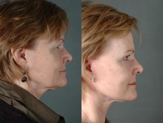 face-and-neck-lift-p1_CG5mLVS.jpg