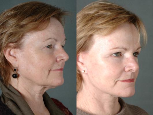 face-and-neck-lift-p1_TyQGuAZ.jpg