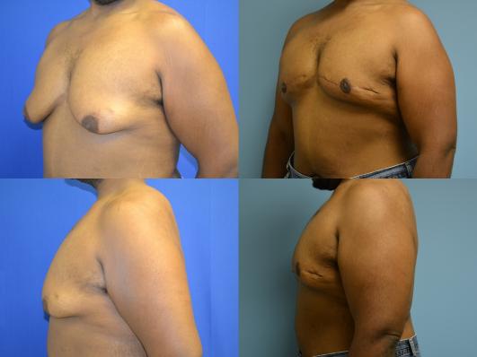 gynecomast1.jpg