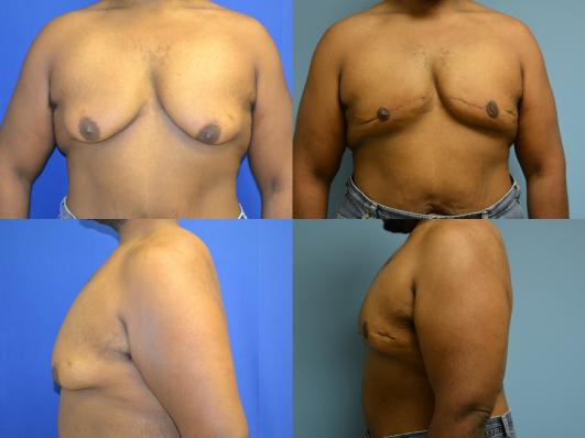 gynecomast2.jpg