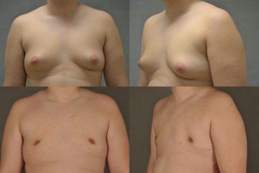 gynecomastia-p1.jpg