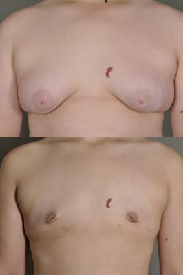 gynecomastia-p2.jpg