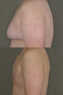 gynecomastia-p2_Ldg6Nj4.jpg