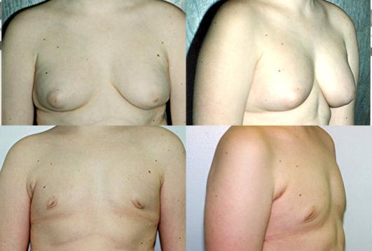 gynecomastia-p5.jpg