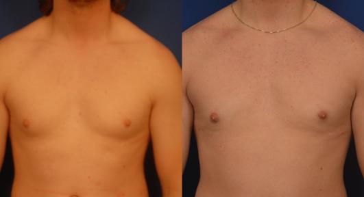 gynecomastia.jpg