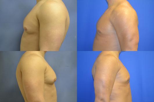 gynecomastia1.jpg