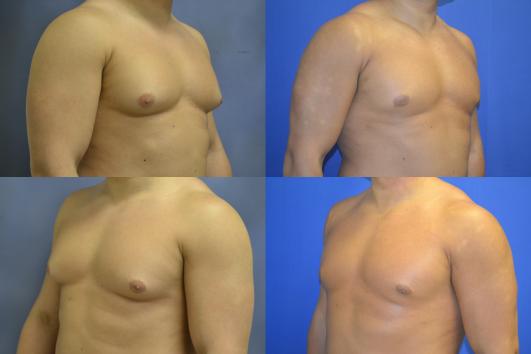 gynecomastia2.jpg