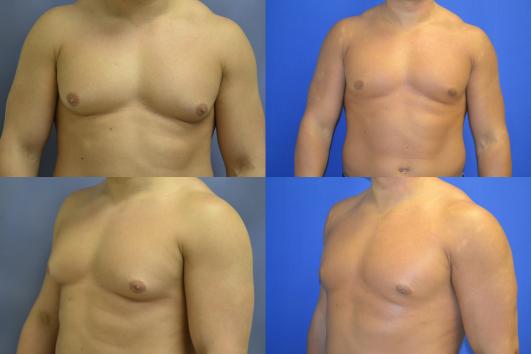 gynecomastia3.jpg