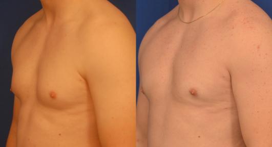 gynecomastia_2.jpg