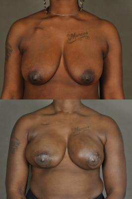 latissimus-flap-breast-reconstruction-p2.jpg
