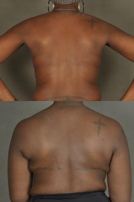 latissimus-flap-breast-reconstruction-p2_sC8yKsG.jpg