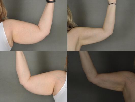 liposuction-arms-p1.jpg