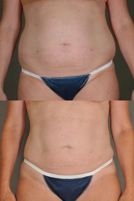 liposuction-p5.jpg