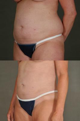 liposuction-p5_VTH86Ld.jpg