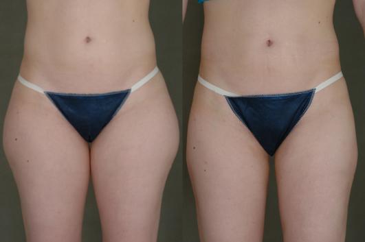 liposuction-p6_8T4f9JL.jpg