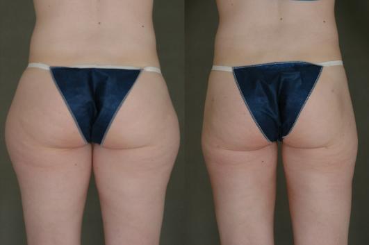 liposuction-p6_rJWeX8D.jpg