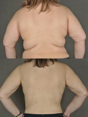liposuction-p7.jpg