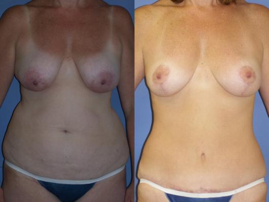 mommy-makeover-breast-lift-and-tummy-tuck-p1.jpg