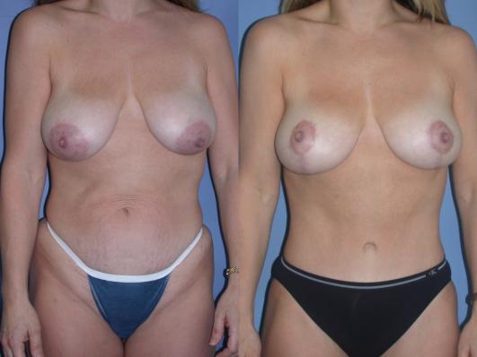 mommy-makeover-liposuction-breast-lift-tummy-p1_eR8eB6S.jpg