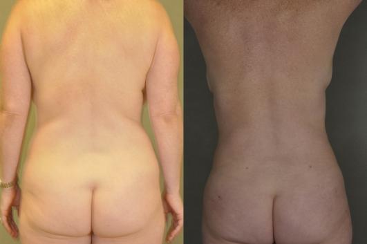 mommy-makeover-tummy-tuck-liposuction-and-br-p1_cxQuKXt.jpg