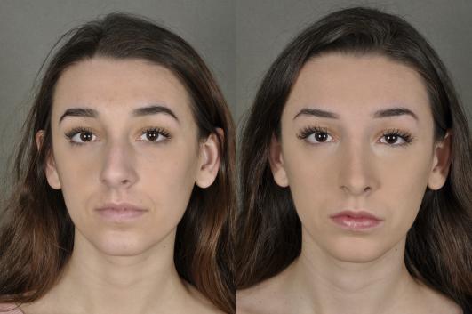 nose-rhinoplasty-p1.jpg