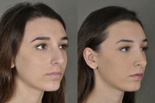 nose-rhinoplasty-p1_2m5VVj4.jpg