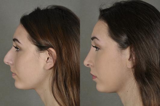 nose-rhinoplasty-p1_cTxuxW4.jpg