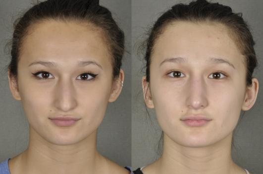 nose-rhinoplasty-p2.jpg