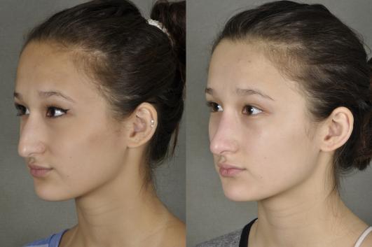 nose-rhinoplasty-p2_1PHBJDT.jpg