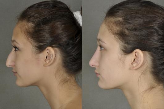 nose-rhinoplasty-p2_u0Y5GwG.jpg