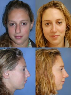 nose-rhinoplasty-p3.jpg