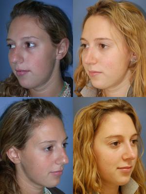 nose-rhinoplasty-p3_X4ZjwaX.jpg