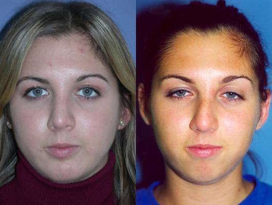 nose-rhinoplasty-p4.jpg