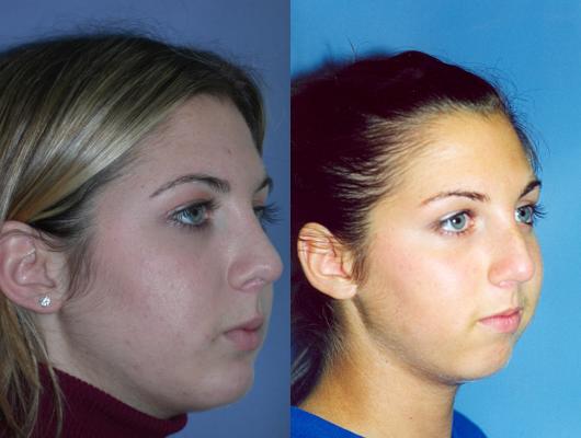 nose-rhinoplasty-p4_oZUQDv5.jpg