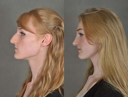 nose-rhinoplasty-p5_DOKorBd.jpg