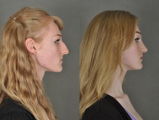 nose-rhinoplasty-p5_Ypi04Bg.jpg