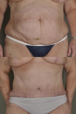 oncoplastic-breast-reduction-p4_yfSYKsb.jpg