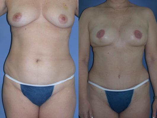 tram-flap-breast-reconstruction-p14_cwv33jm.jpg