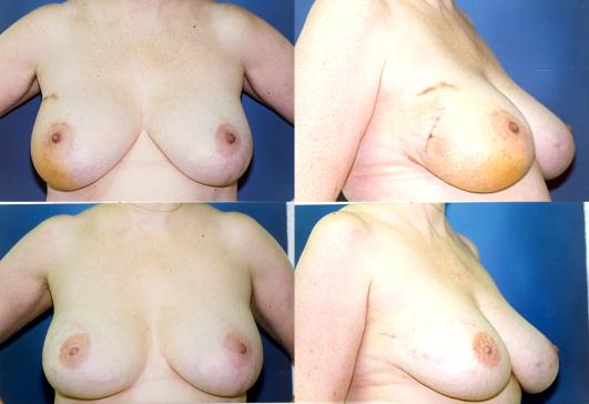 tram-flap-breast-reconstruction-p28.jpg