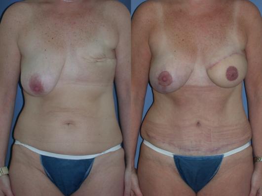 tram-flap-breast-reconstruction-p29.jpg