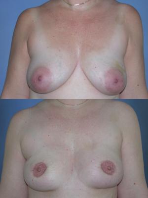 tram-flap-breast-reconstruction-p34.jpg