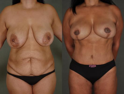 tram-flap-breast-reconstruction-p5.jpg