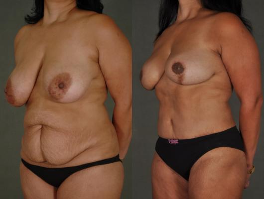 tram-flap-breast-reconstruction-p5_TFciuFs.jpg