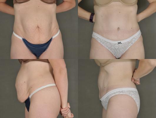 tummy-tuck-and-liposuction-p8.jpg