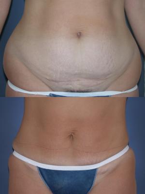 tummy-tuck-p1.jpg