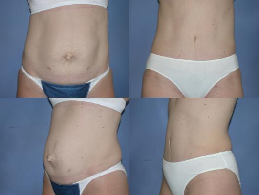 tummy-tuck-p10.jpg