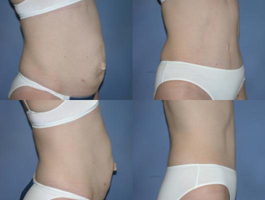 tummy-tuck-p10_5216Sng.jpg